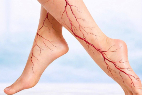 Варикоз на ранней стадии: как распознать болезнь до появления вен